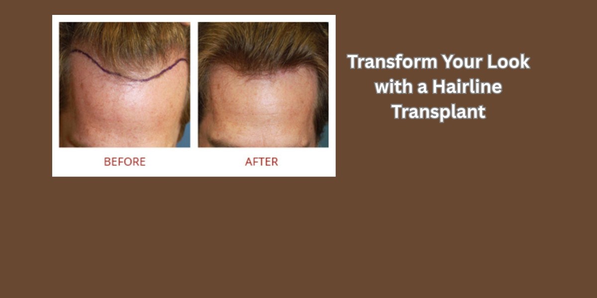 Transform Your Look with a Hairline Transplant